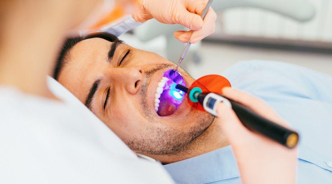 Dental Sealants Dental Sealants