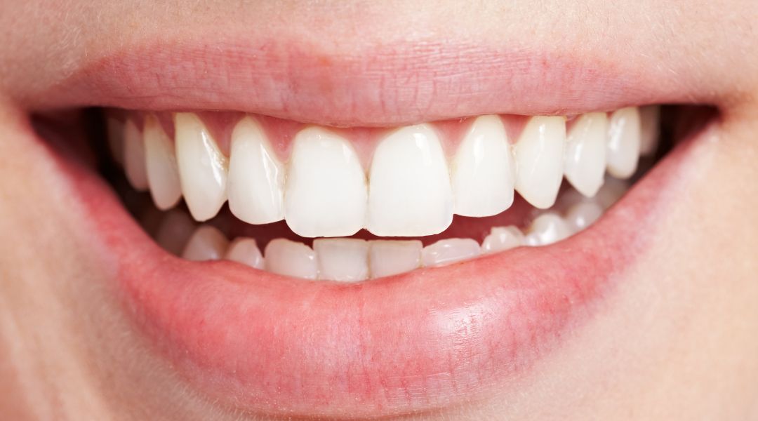 dental bonding dental bonding